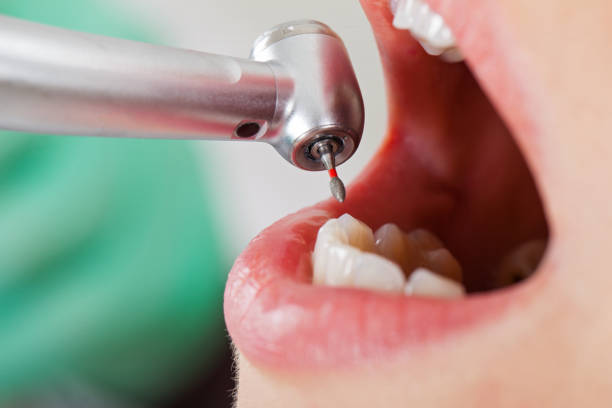 Best Emergency Wisdom Teeth Removal in Howey In The Hills, FL